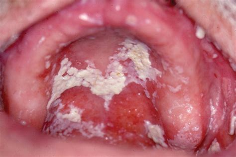 Candida Albicans Buccal Causes Yeast Infection And Candida Albicans