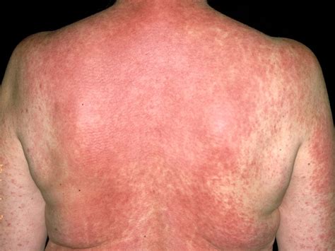 long  drug allergy rash    allergy trigger
