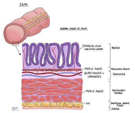 differentiated neuroendocrine tumour colon  rectum mypathologyreportca