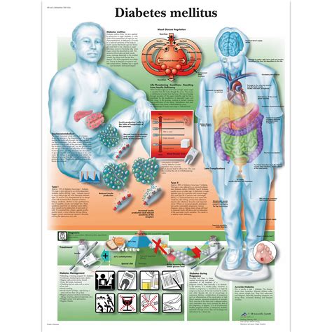 diabetes chart diabetes poster anatomical charts anatomy posters health education charts