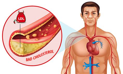 ldl cholesterol    called  bad cholesterol dr sam robbins