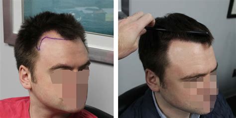 hair transplant surgery aesthetic details temple hairline restoration