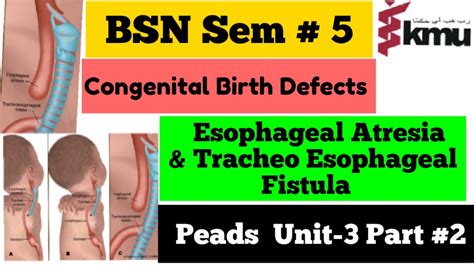 Esophageal Atresia And Tracheoesophageal Fistula Pediatric Health