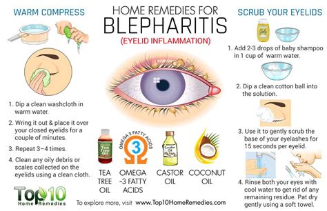 home remedies  blepharitis eyelid inflammation top  home remedies