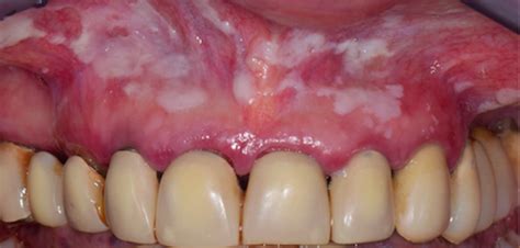 multiple white lesions dentistry