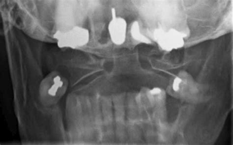 Odontoid Fracture Spine Orthobullets