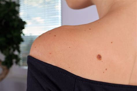 ask the expert is it normal to get new moles in your 30s