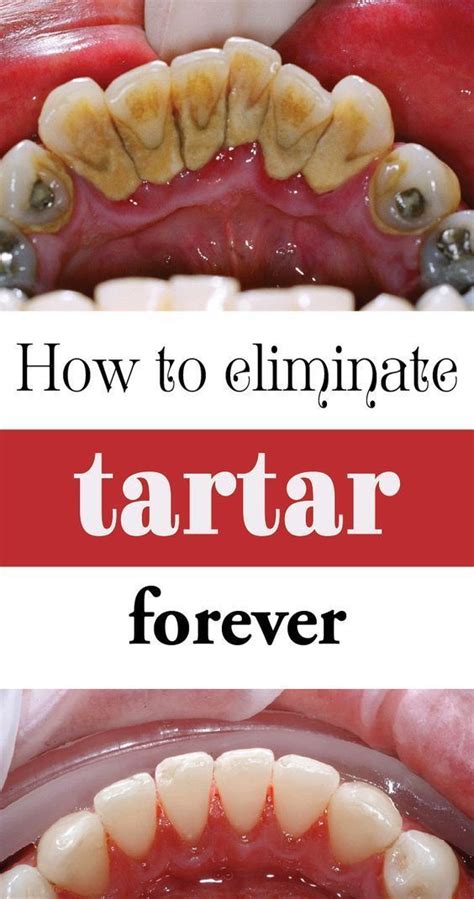 10 effective tricks to remove plaque and tartar be your own dentist