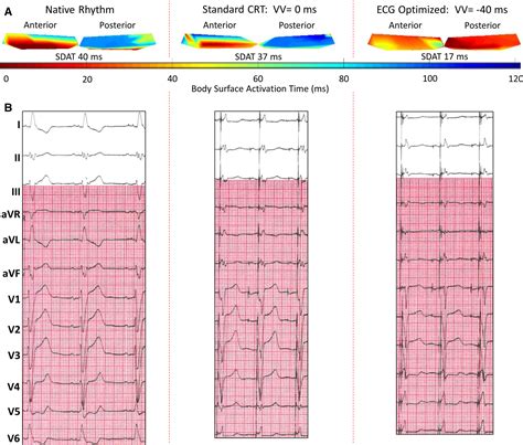 Twelve‐lead Ecg Optimization Of Cardiac Resynchronization Therapy In