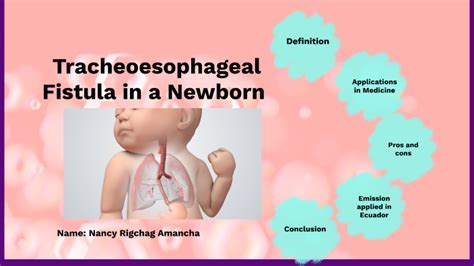 Tracheoesophageal Fistula In A Newborn By Nancy Amancha