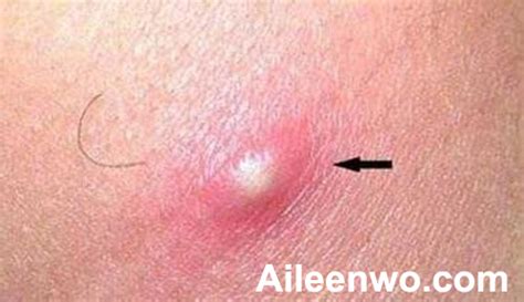 Skin Rashes In Hiv Symptoms Aileenwo