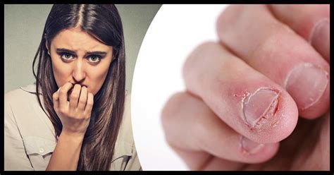 nail biting isnt   bad habit   health hazard