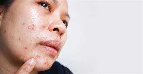 treat acne   mouth   reasons youre breaking