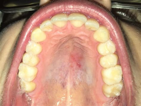 equilibre se raser celibataire red spots  mouth eveiller