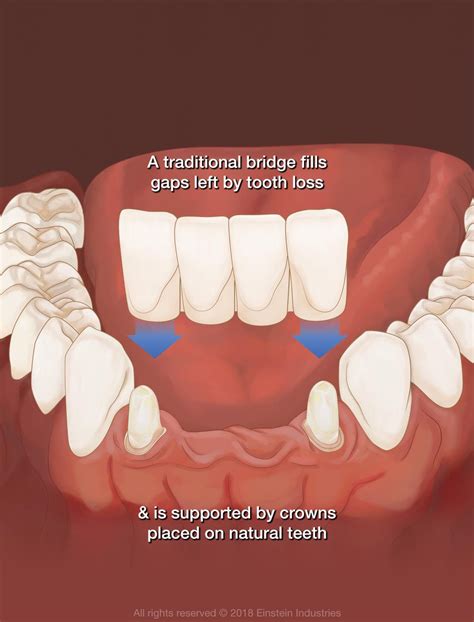 implant supported bridge   front teeth harrisonburg va