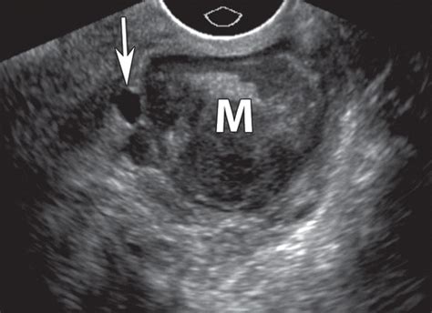 us of the nongravid cervix with multimodality imaging correlation