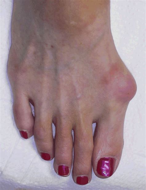 great toe bunion bunion relief