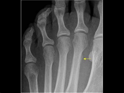 Musculoskeletal Joints And Tendons 6 8 Foot Case 6 8 7 Bony Lesions