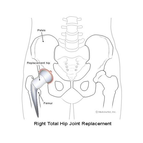 Total Hip Arthroplasty Exercises For After Your Hip