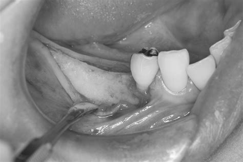 安全で確実なインプラント治療を心がけております。 – 石神井公園 歯医者 – たけのうち歯科クリニック