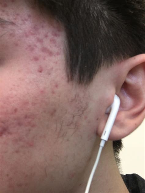 acne dermarolling  acne scars rskincareaddiction