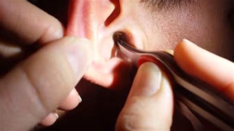 remove impacted earwax specialists remove huge piece  earwax