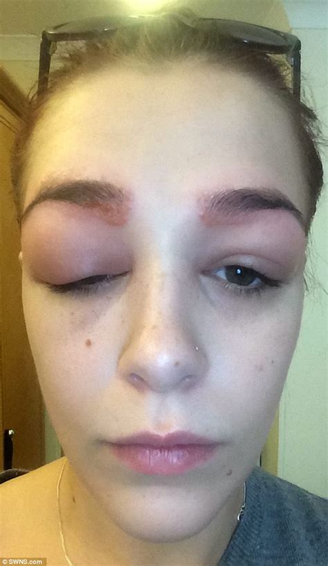 teen had severe allergic reaction to busy eyebrow treatment daily