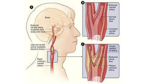 carotid artery disease stenosis symptoms  treatments healthy