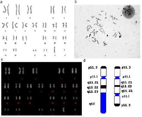 Cytogenetics A Gtg Karyotype 45 X[18] 46 Xy Idic Y Q 11 2 [82] The Y