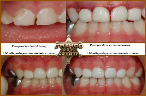 white zirconia dental crowns  children dr paul rubin frisco