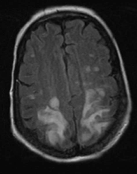 Cureus Status Epilepticus And Blindness In A Patient With Carfilzomib