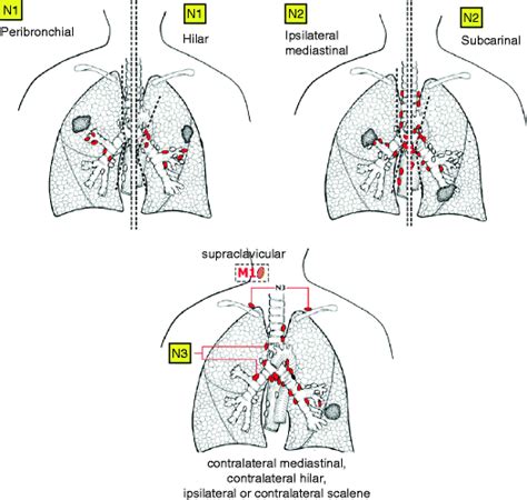 Lung Cancer Springerlink