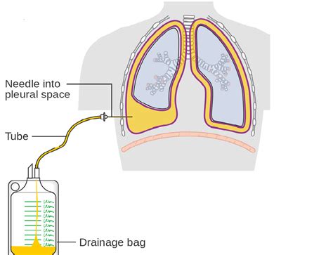 pleural fluid drainage frequency dr flores pulmonology