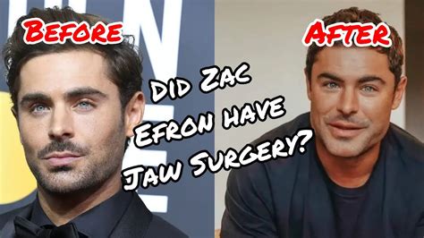 zac efron before and after broken jaw and surgery nip talk ep 8