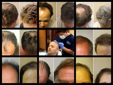 before and after photos show amazing hair transplant results boston ma