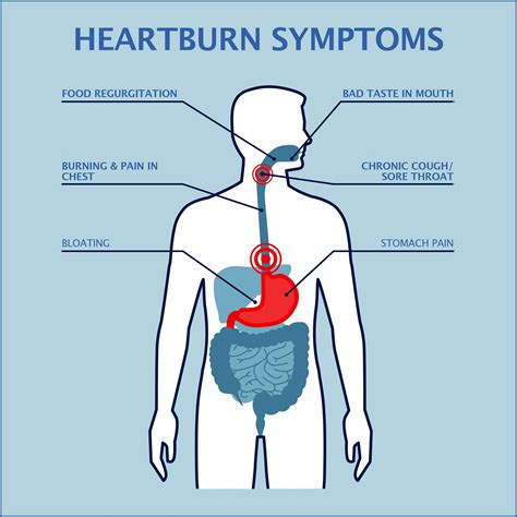 heartburn graphics min gastroenterology  greater orlando