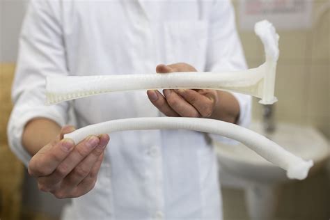 Patient Receives A 3d Printed Rib For The First Time In Bulgaria