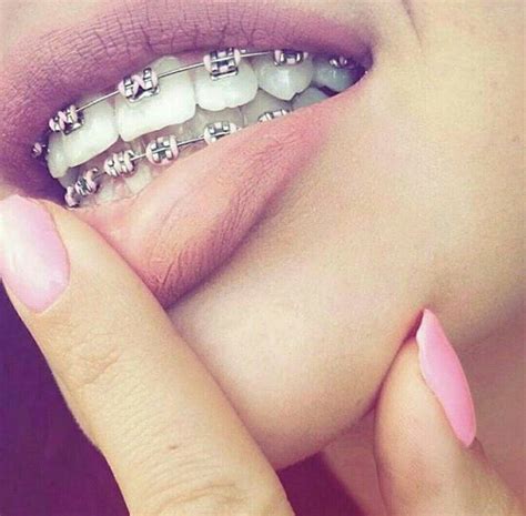 feedback braces teeth colors pink braces cute braces colors teeth