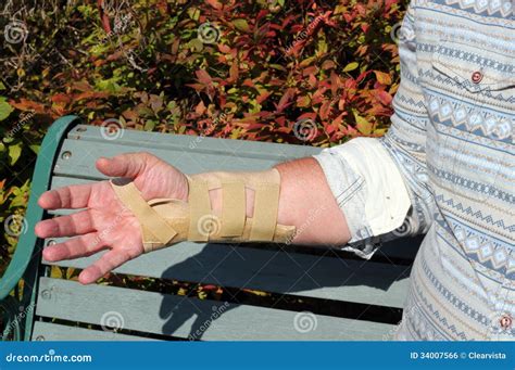 wrist splint strapping  repetitive strain injury stock photo