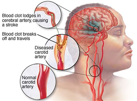 ischemic stroke  signs symptoms ischemic stroke treatment