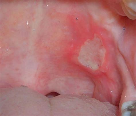 crohn s mouth ulcers symptoms causes and treatments