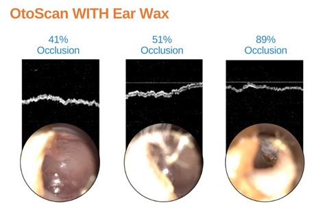earwax  met  match   otosight middle ear scope photonicare