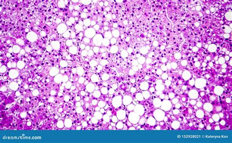 histopathology  liver steatosis  fatty liver stock image image  degeneration