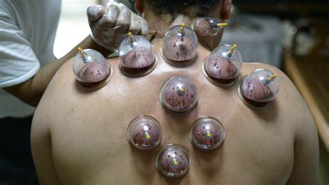 olympic cupping a practice rooted in ancient islam big