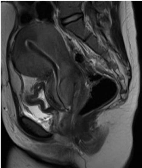 mri image of large bulky cervix with posterior mass contiguous with