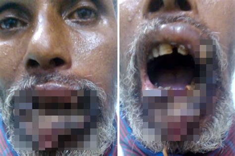 man  maggot infested lips    horrific video  daily star