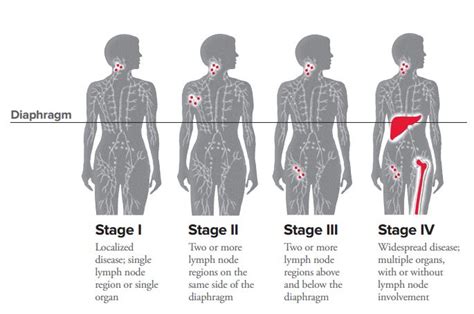 Hodgkins Lymphoma Cancer Stage 3 Survival Rate