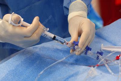 administering local anesthetic stock image  science photo library
