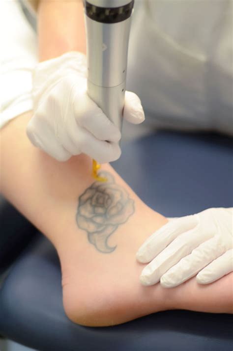 tattoo removal  blue water spa  raleigh nc