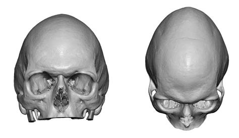 blog archivecase study sagittal crest head reshaping